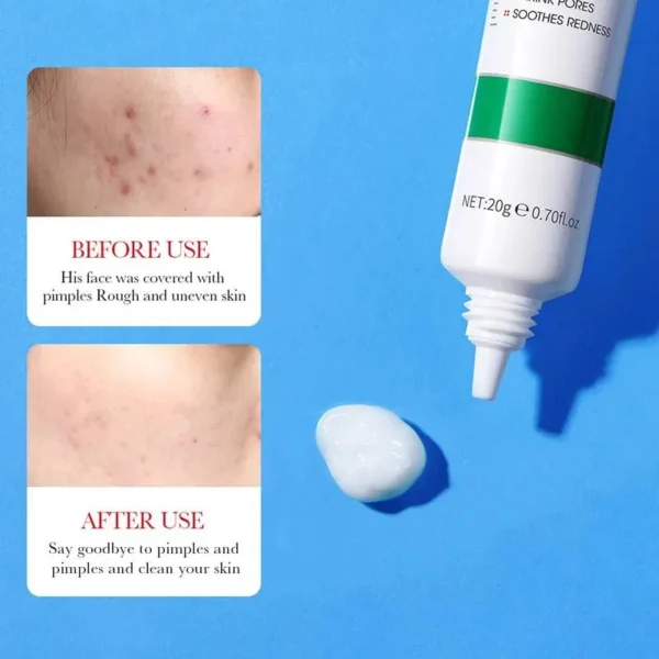 Bioaqua Salicylic Acid Acne Removal cream - Image 3